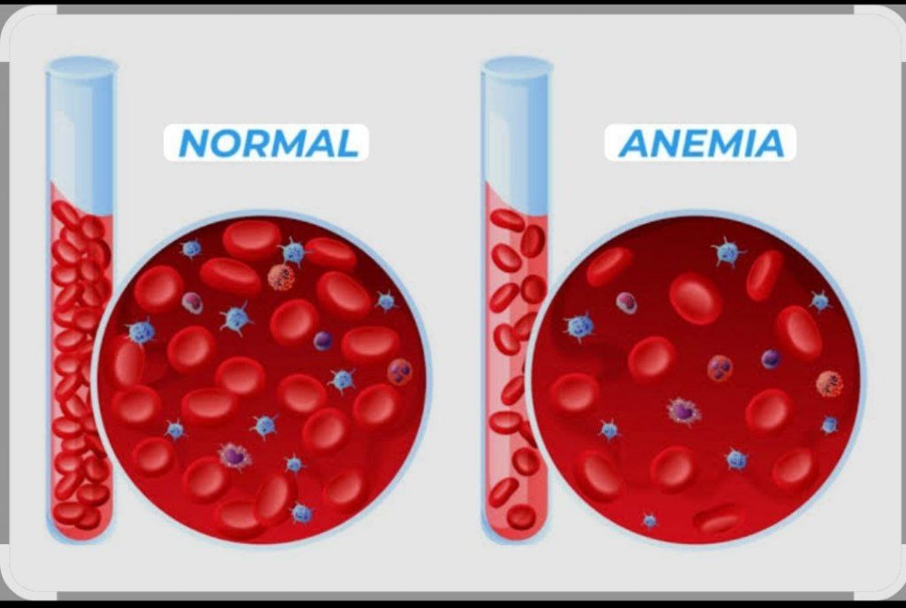 Illustration comparing normal red blood cell levels with anemia, showing reduced red blood cells and hemoglobin in anemia.