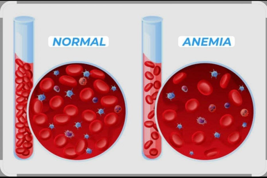 Illustration comparing normal red blood cell levels with anemia, showing reduced red blood cells and hemoglobin in anemia.